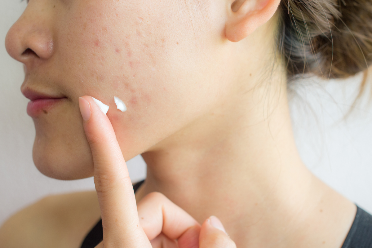 What are Acne Scars? Are these Attractive?