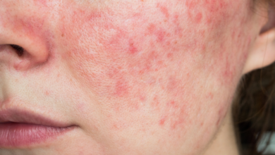 Rosacea: Symptoms and Causes