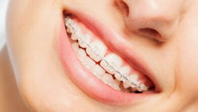 Compare Braces of Teeth Costs Using These 5-Factors