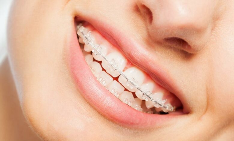 Compare Braces of Teeth Costs Using These 5-Factors