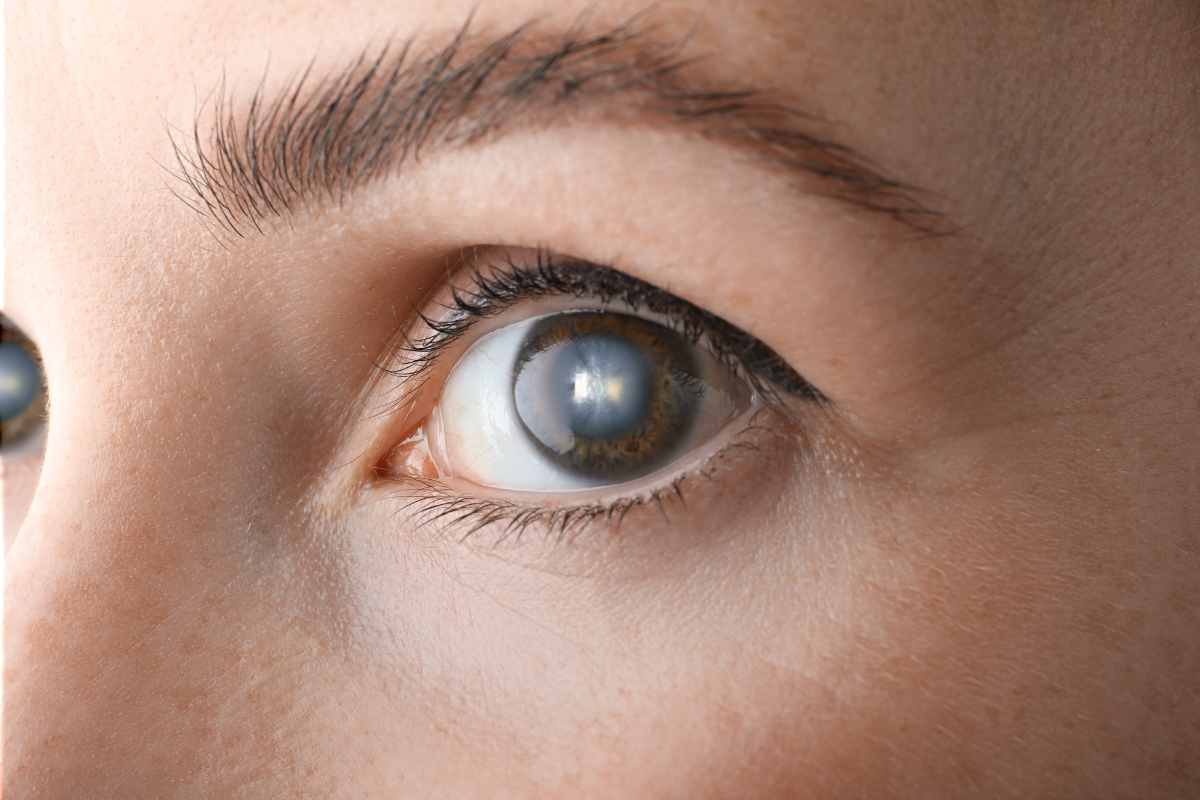 Does Cataract Surgery Affect Your Lifestyle